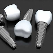 Dental Implants